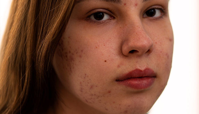 آیا نیاسینامید به درمان جوش کمک می کند ؟ -داریو درمان آرا