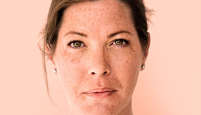 ترانگزامیک اسید راهکار نوین در درمان لک_های پوستی-داریو درمان آرا