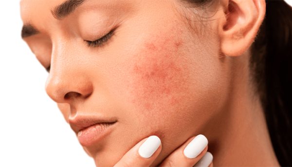 ترانگزامیک اسید و پوست صورت-داریو درمان آرا