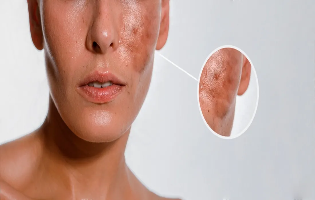 عوارض جانبی و موارد منع مصرف ترانگزامیک اسید-داریو درمان آرا