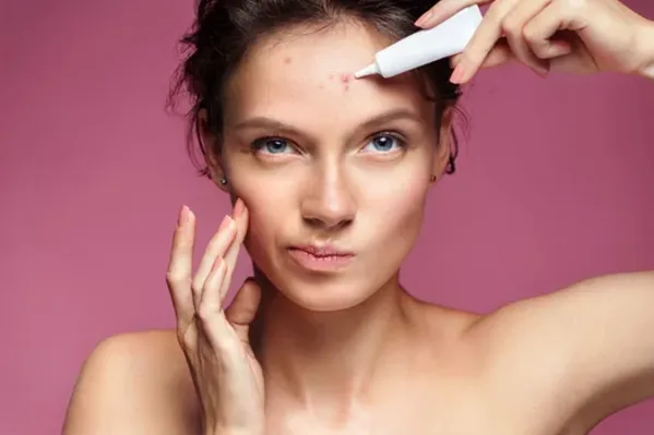 مزایای نیاسنامید برای انواع آکنه-داریو درمان آرا