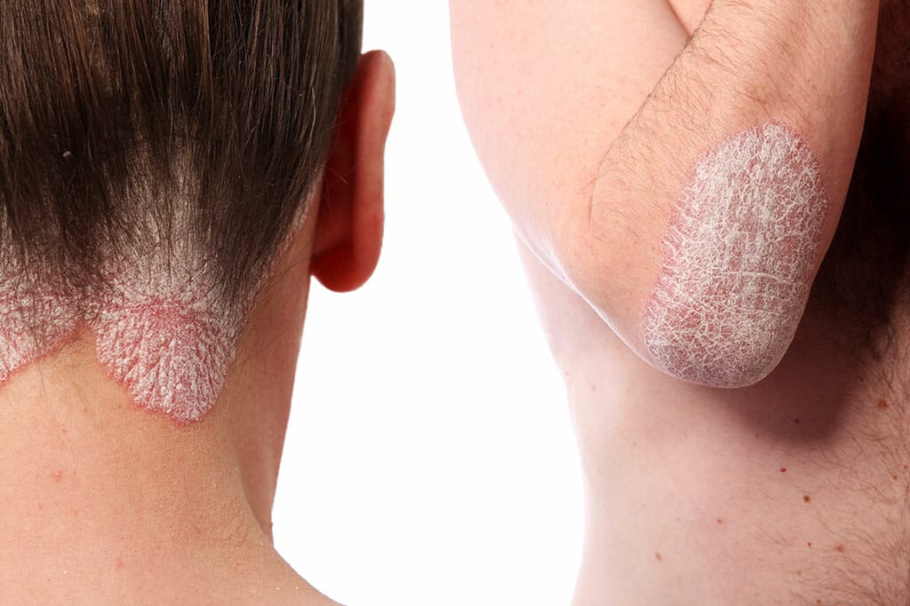 پسوریازیس چیست-داریو درمان آرا