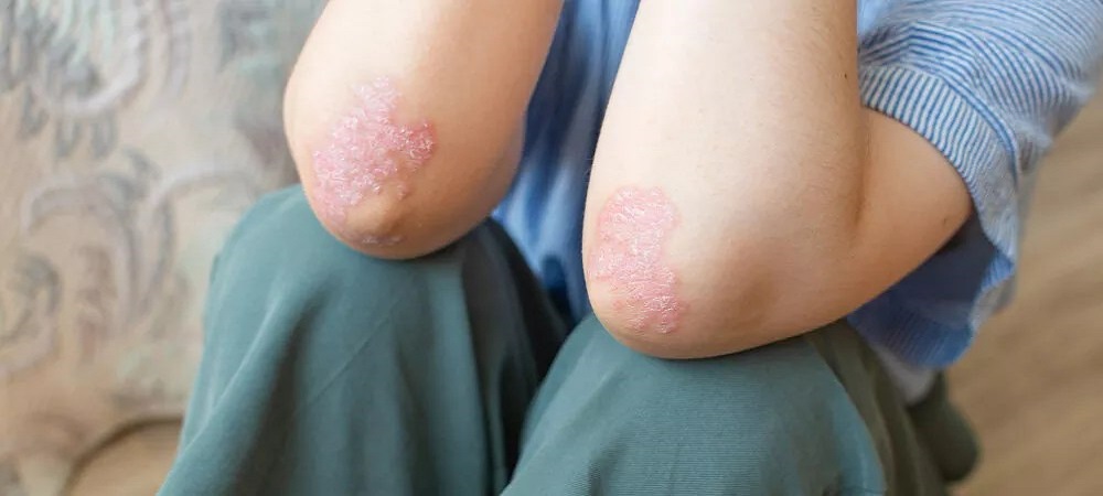 درمان و مدیریت خشکی شدید پوست-داریو درمان آرا