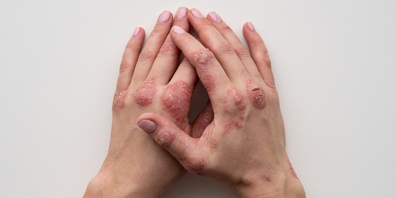 خشکی پوست چیست و چرا ایجاد می‌شود؟-داریو درمان آرا