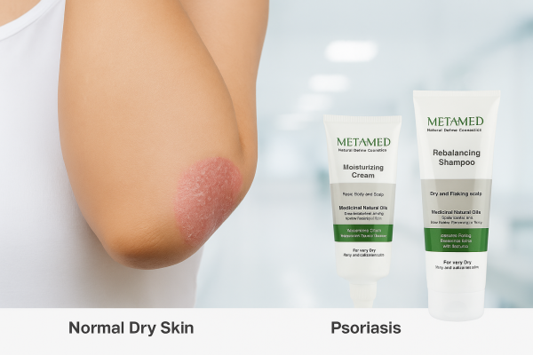 تفاوت خشکی پوستی معمولی با خشکی ناشی از پسوریازیس؛ راهنمای تشخیص 2 پسوریازیس چیست و چگونه موجب خشکی میشود؟